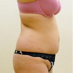Liposuction Before & After Patient #1180