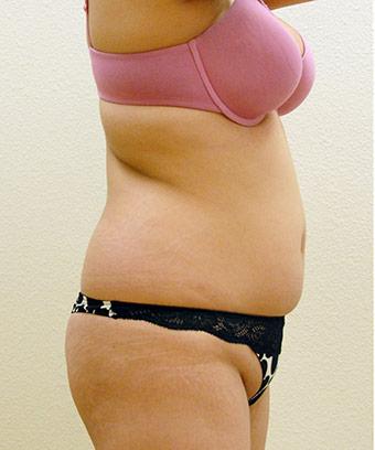 Liposuction Before & After Patient #1180