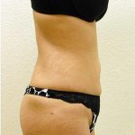 Liposuction Before & After Patient #1180
