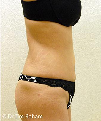 Liposuction Before & After Patient #1180
