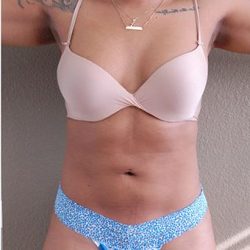 Liposuction Before & After Patient #1182