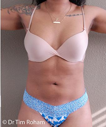 Liposuction Before & After Patient #1182