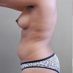 Liposuction Before & After Patient #1182