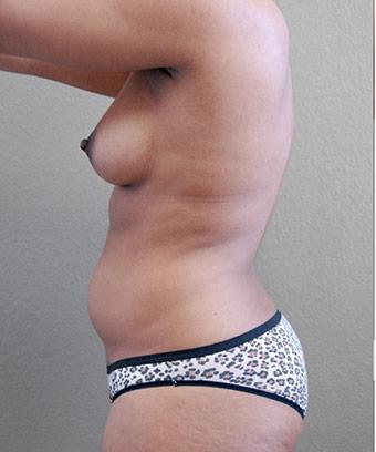 Liposuction Before & After Patient #1182