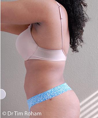 Liposuction Before & After Patient #1182