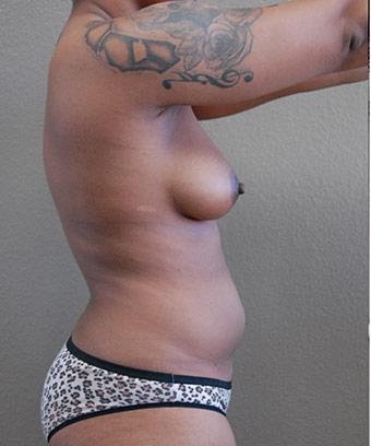 Liposuction Before & After Patient #1182
