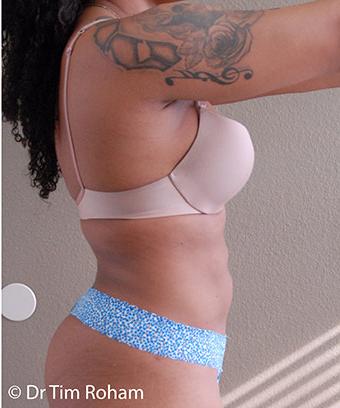 Liposuction Before & After Patient #1182