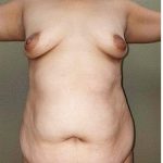 Mommy Makeover Before & After Patient #1236