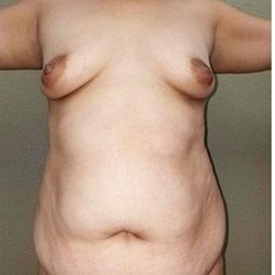 Mommy Makeover Before & After Patient #1236