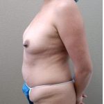 Mommy Makeover Before & After Patient #1238