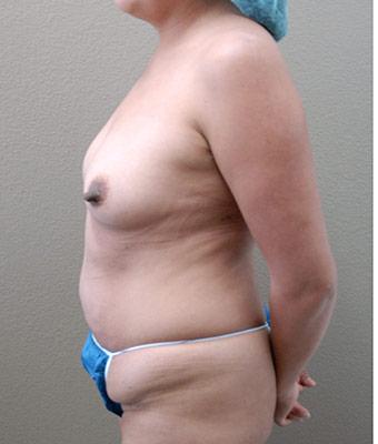 Mommy Makeover Before & After Patient #1238