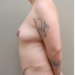 Mommy Makeover Before & After Patient #1239