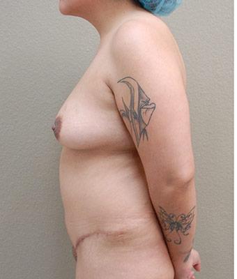Mommy Makeover Before & After Patient #1239
