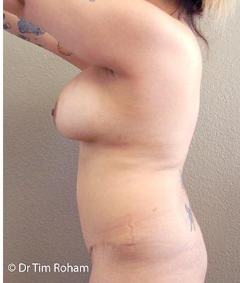Mommy Makeover Before & After Patient #1239