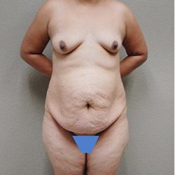 Mommy Makeover Before & After Patient #1241