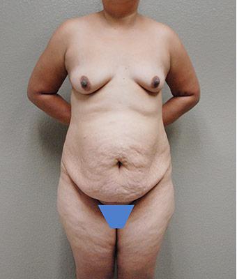 Mommy Makeover Before & After Patient #1241
