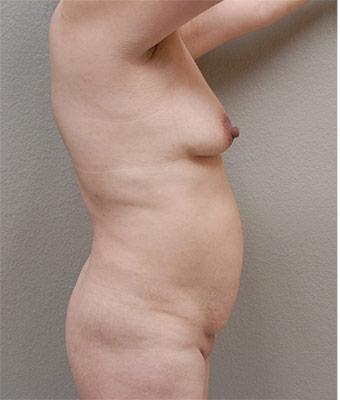 Mommy Makeover Before & After Patient #1226