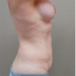 Mommy Makeover Before & After Patient #1227