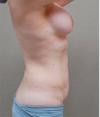 Mommy Makeover Before & After Patient #1227