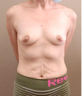 Mommy Makeover Before & After Patient #1228