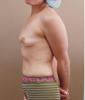 Mommy Makeover Before & After Patient #1228