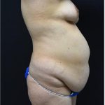 Mommy Makeover Before & After Patient #1229