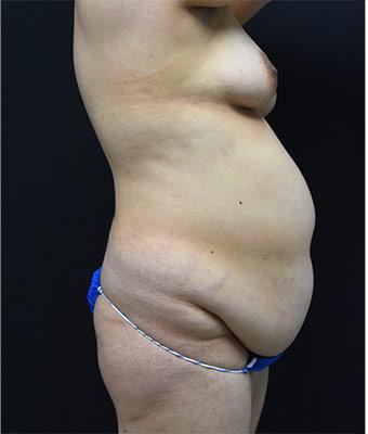 Mommy Makeover Before & After Patient #1229