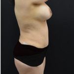 Mommy Makeover Before & After Patient #1229