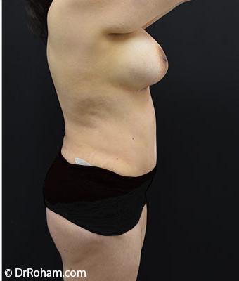 Mommy Makeover Before & After Patient #1229