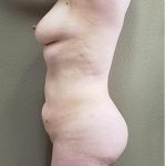 Mommy Makeover Before & After Patient #1230