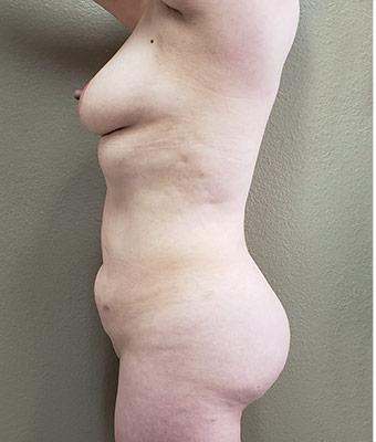 Mommy Makeover Before & After Patient #1230