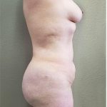 Mommy Makeover Before & After Patient #1230