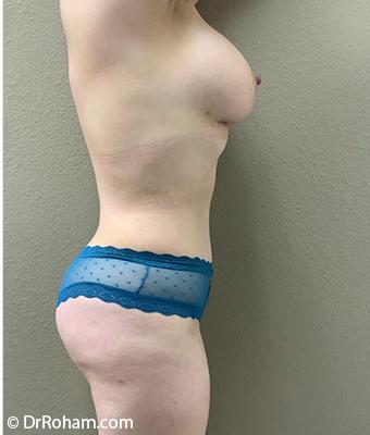 Mommy Makeover Before & After Patient #1230