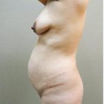 Mommy Makeover Before & After Patient #1231