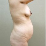 Mommy Makeover Before & After Patient #1231