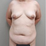 Mommy Makeover Before & After Patient #1233