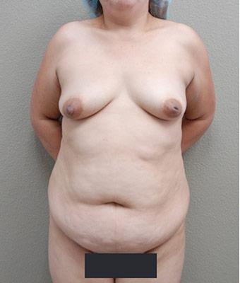 Mommy Makeover Before & After Patient #1233