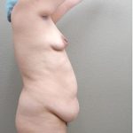 Mommy Makeover Before & After Patient #1233