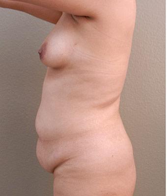 Mommy Makeover Before & After Patient #1234