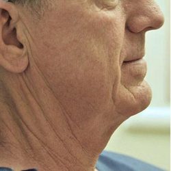 Neck Lift Before & After Patient #1386