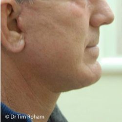 Neck Lift Before & After Patient #1386