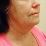 Neck Lift Before & After Patient #1387