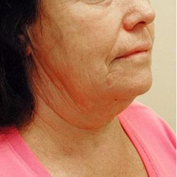 Neck Lift Before & After Patient #1387
