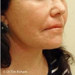 Neck Lift Before & After Patient #1387