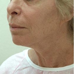 Neck Lift Before & After Patient #1388
