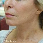Neck Lift Before & After Patient #1388