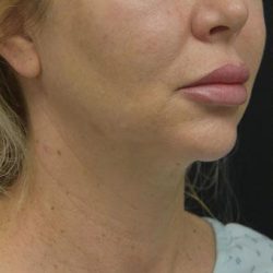 Neck Lift Before & After Patient #1389