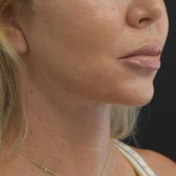 Neck Lift Before & After Patient #1389