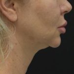 Neck Lift Before & After Patient #1389