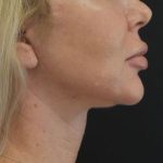 Neck Lift Before & After Patient #1389